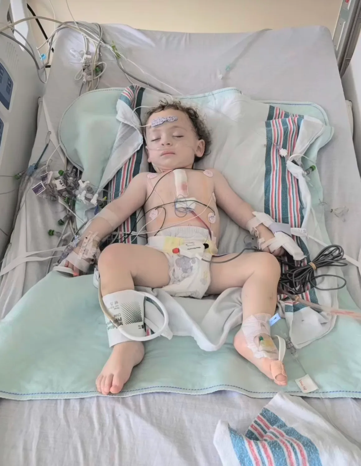 Newborn baby laying on hospital bed, head resting on light blue towel, eyes closed while baby tied to multiple tubes and wires.