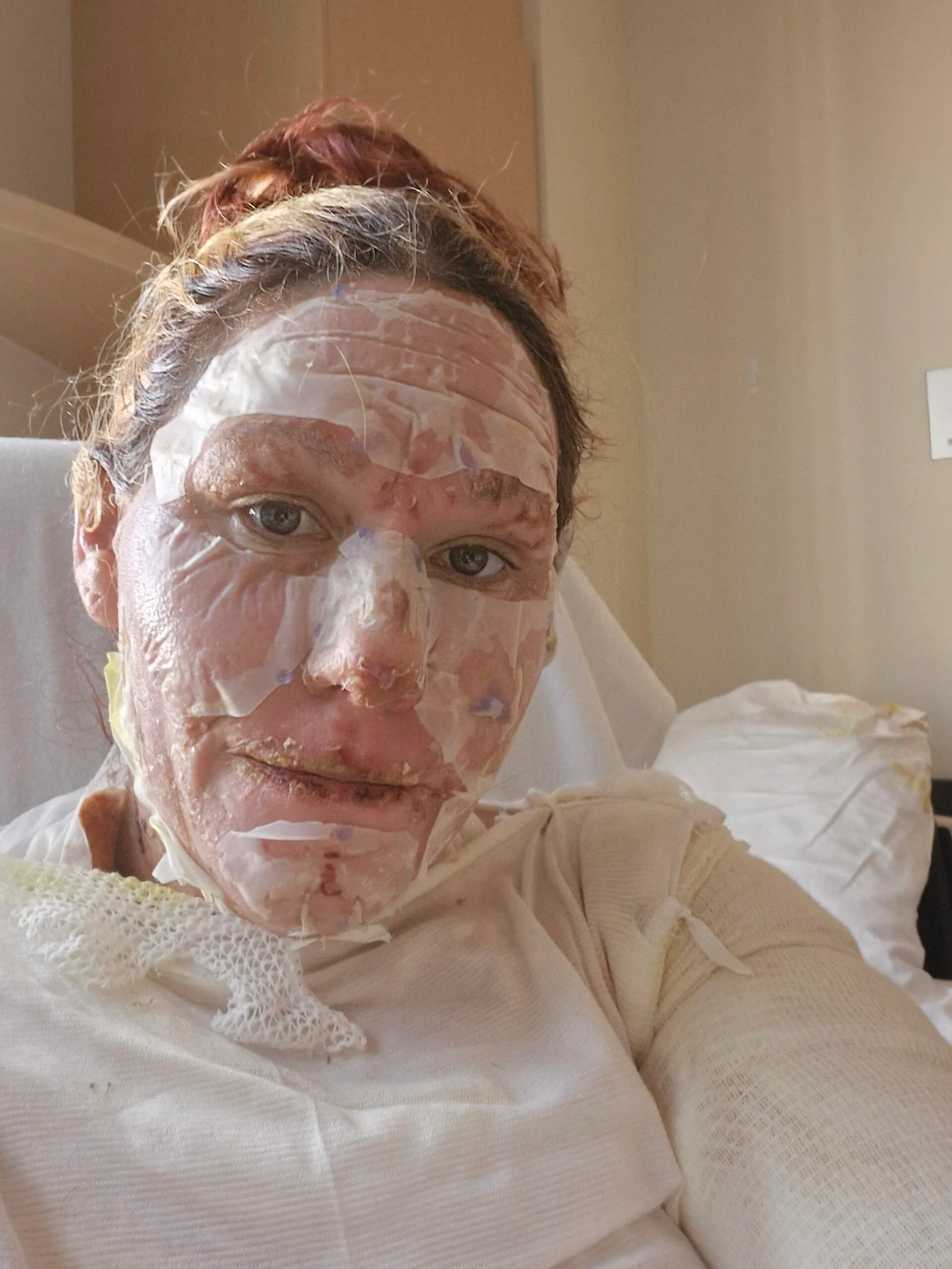 Woman with severely burnt face, covered with bandages, laying on hospital bed staring into camera.