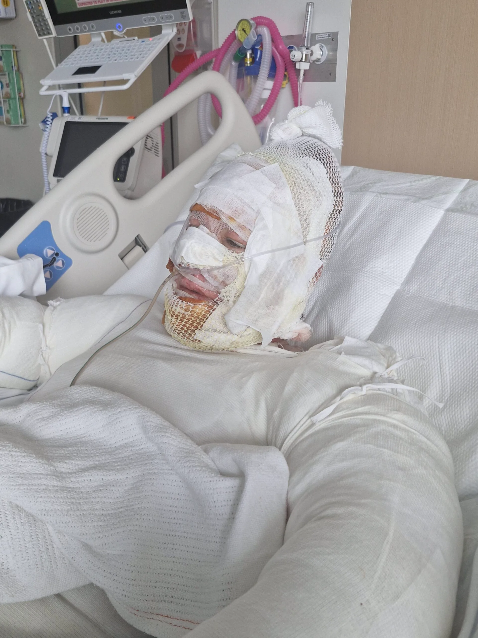 Woman completely covered in bandages and dressing, facing forward and laying on hospital bed.
