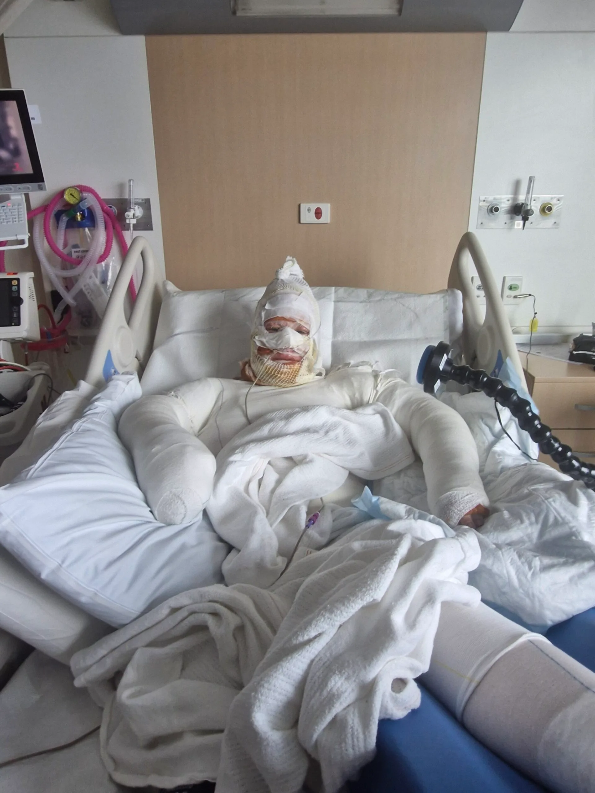 Woman completely covered in bandages and dressing, laying on hospital bed, tied up to tubes.