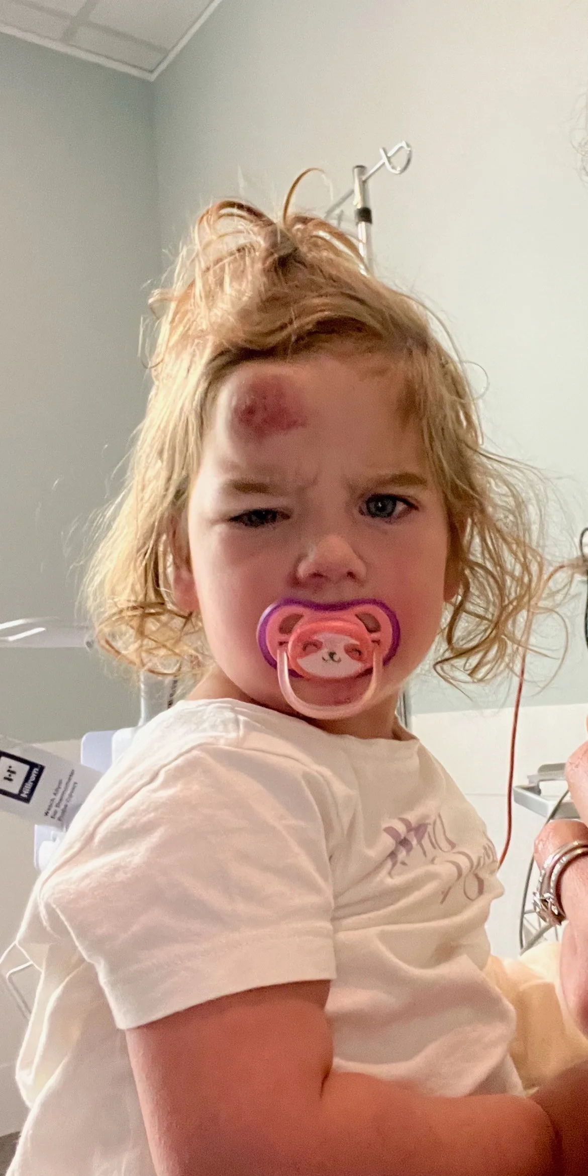 Little girl with blonde hair with dummy in her mouth has massive red lump on her forehead. Staring into camera with distressed look.