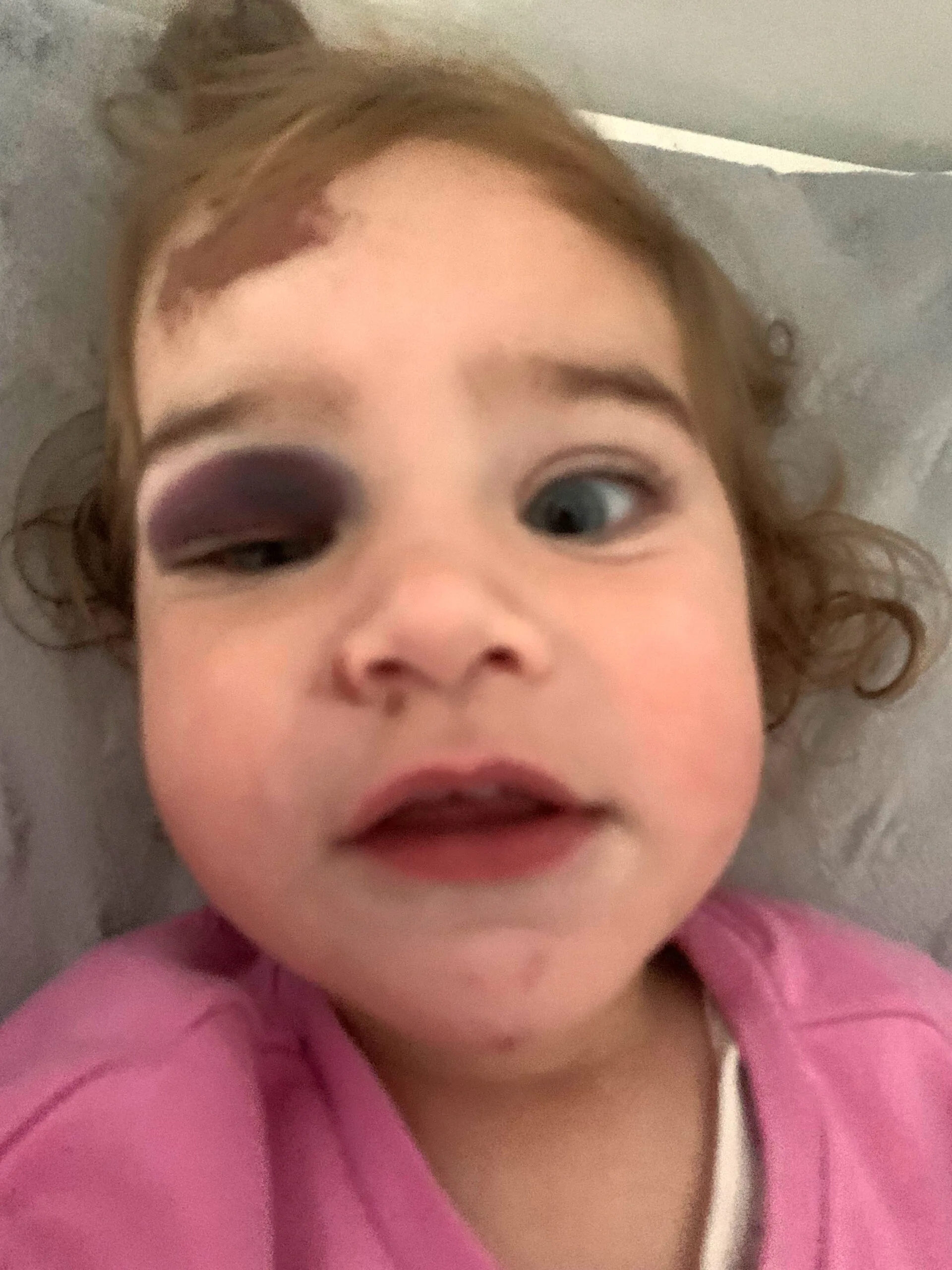 Little girl with blonde hair and blue eyes looking into camera. Left eye is bruised and blackened.