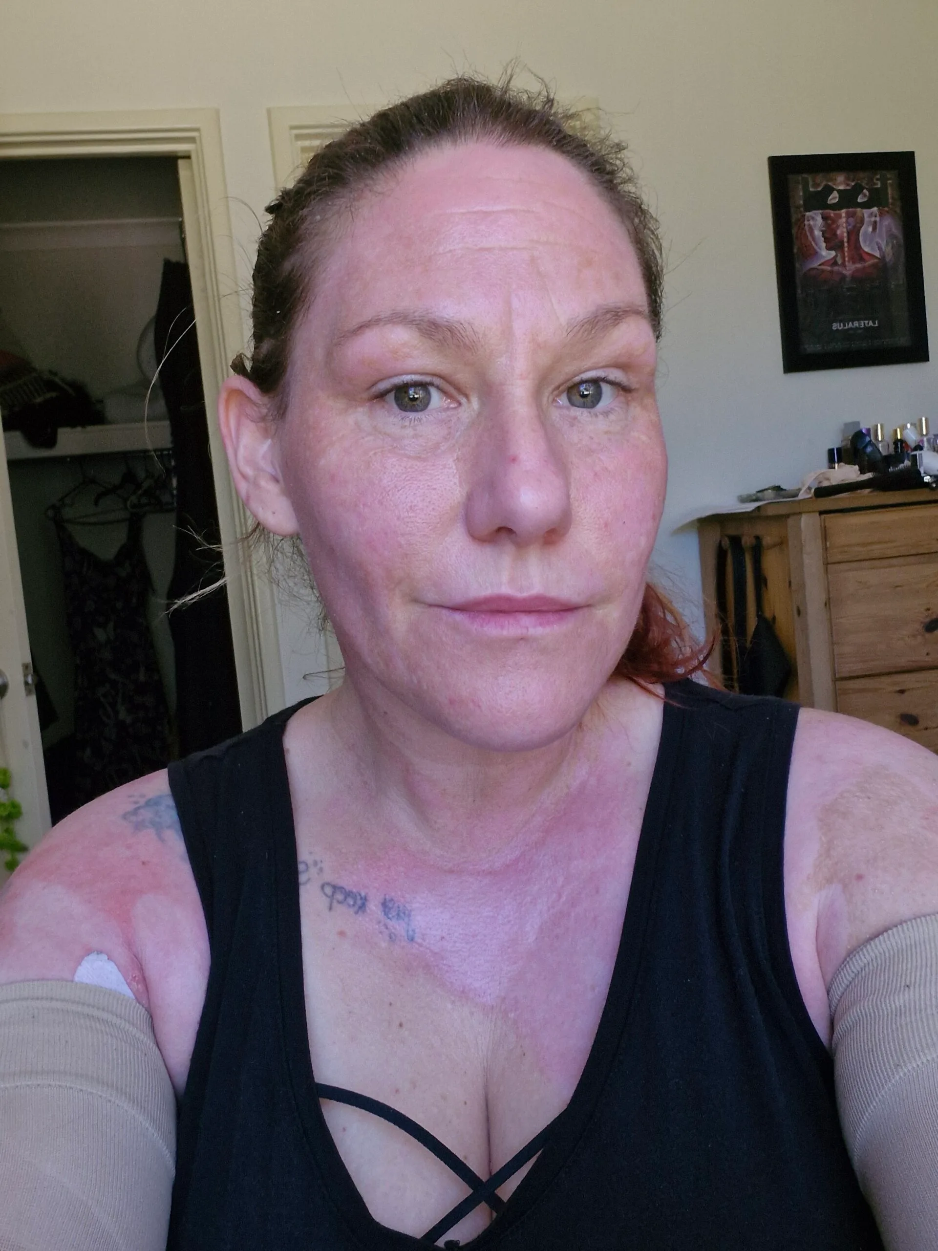 Woman with brown hair, green eyes, has large burnt scars across chest and arms.