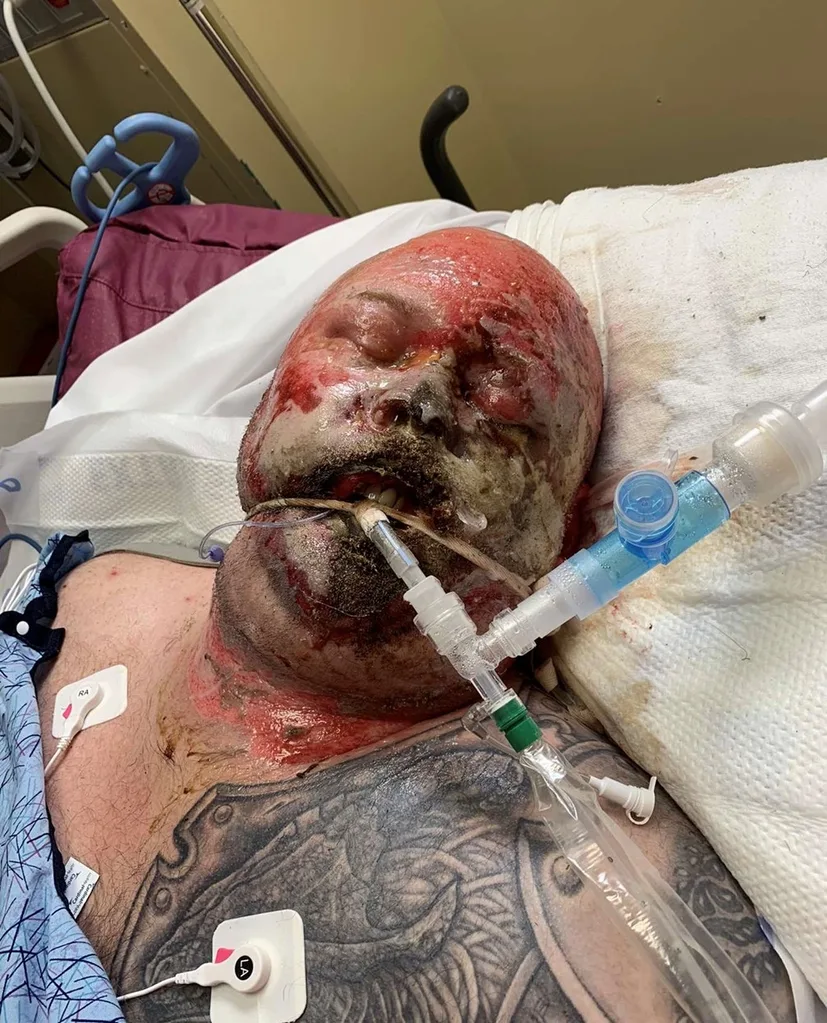 Image of man in hospital after being electrocuted at work