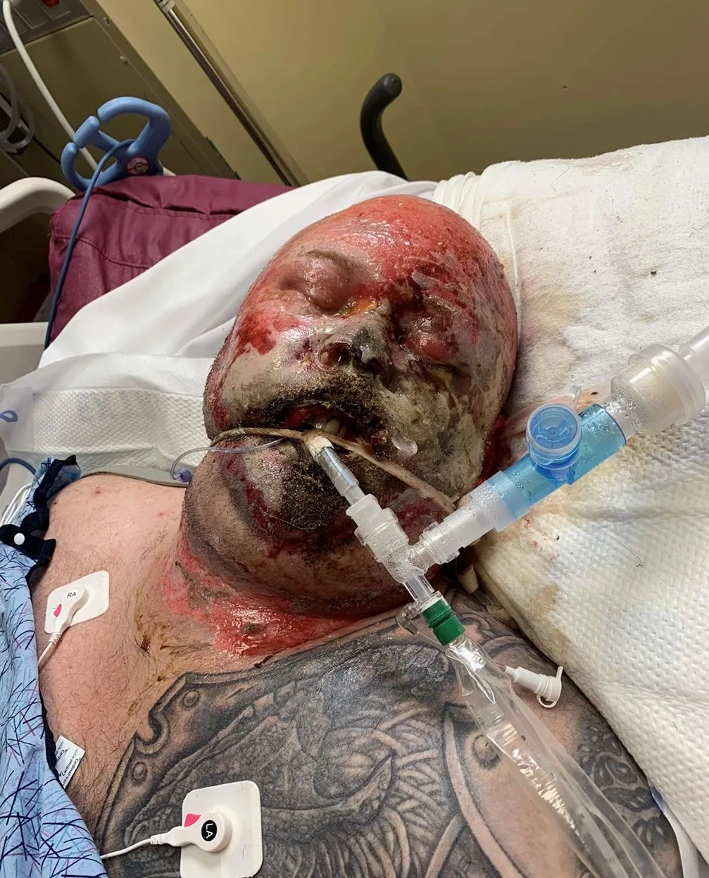 Image of man in hospital after being electrocuted at work