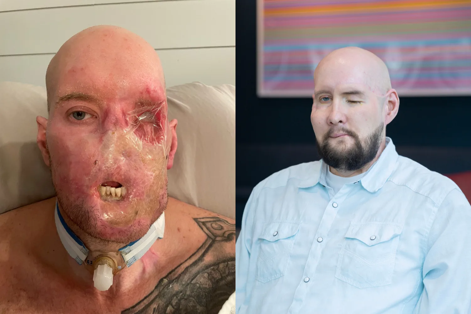 Image on left - man who suffered electric shock to face Image on right - Man after face transplant