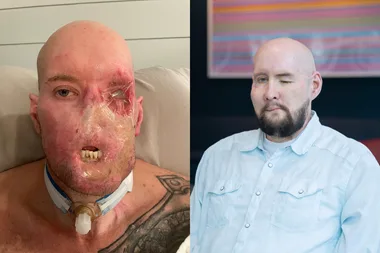 Image on left - man who suffered electric shock to face Image on right - Man after face transplant