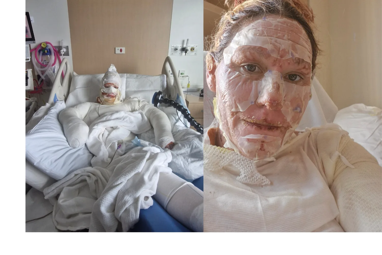 Left: Woman completely covered in bandages and dressing, laying on hospital bed, tied up to tubes. Right: Woman with severely burnt face, covered with bandages, laying on hospital bed staring into camera.