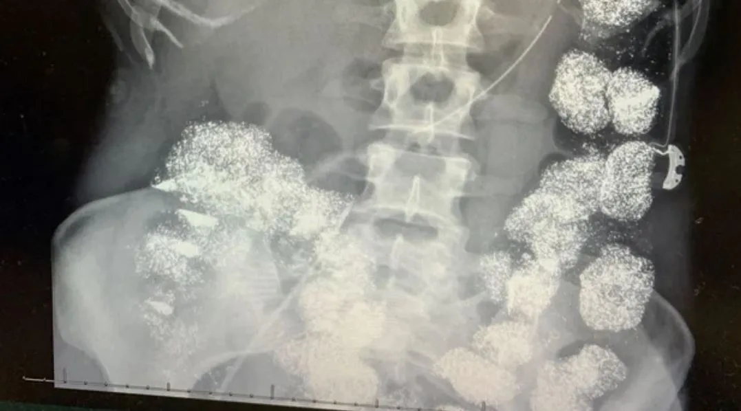 X-ray image of injuries