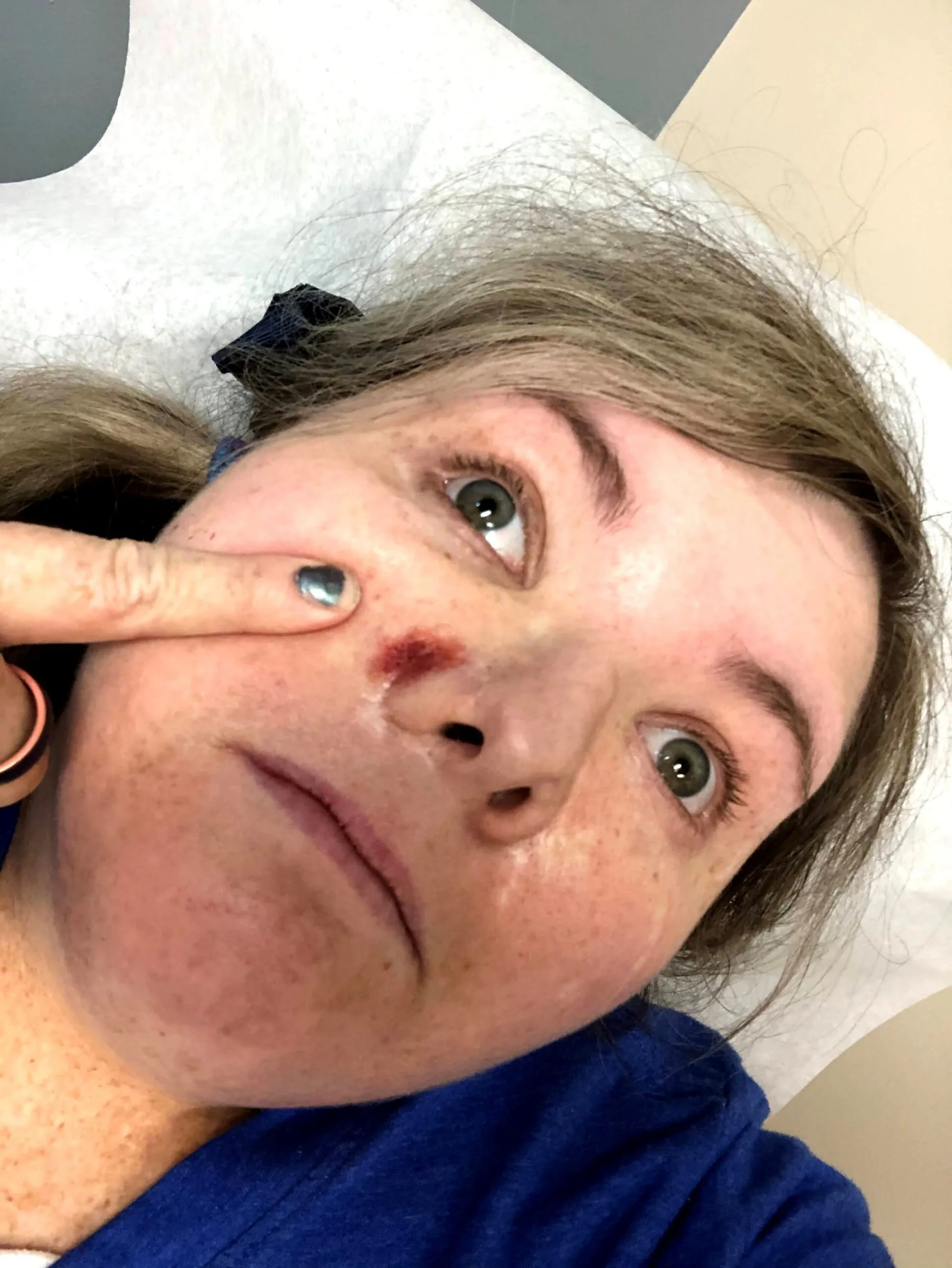 woman with red welt on nose 