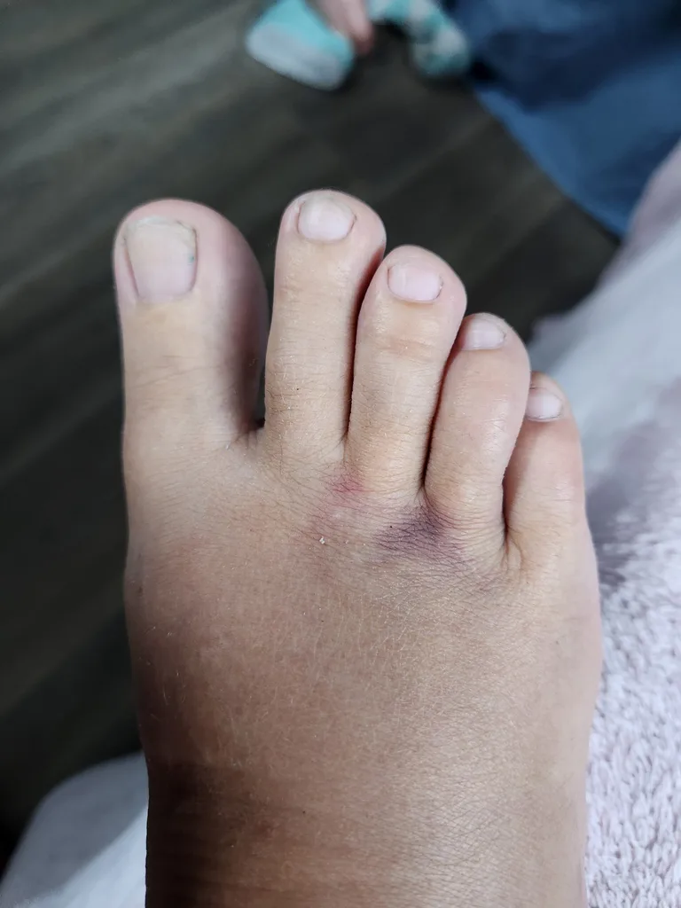 Image of bruised foot after wombat attack