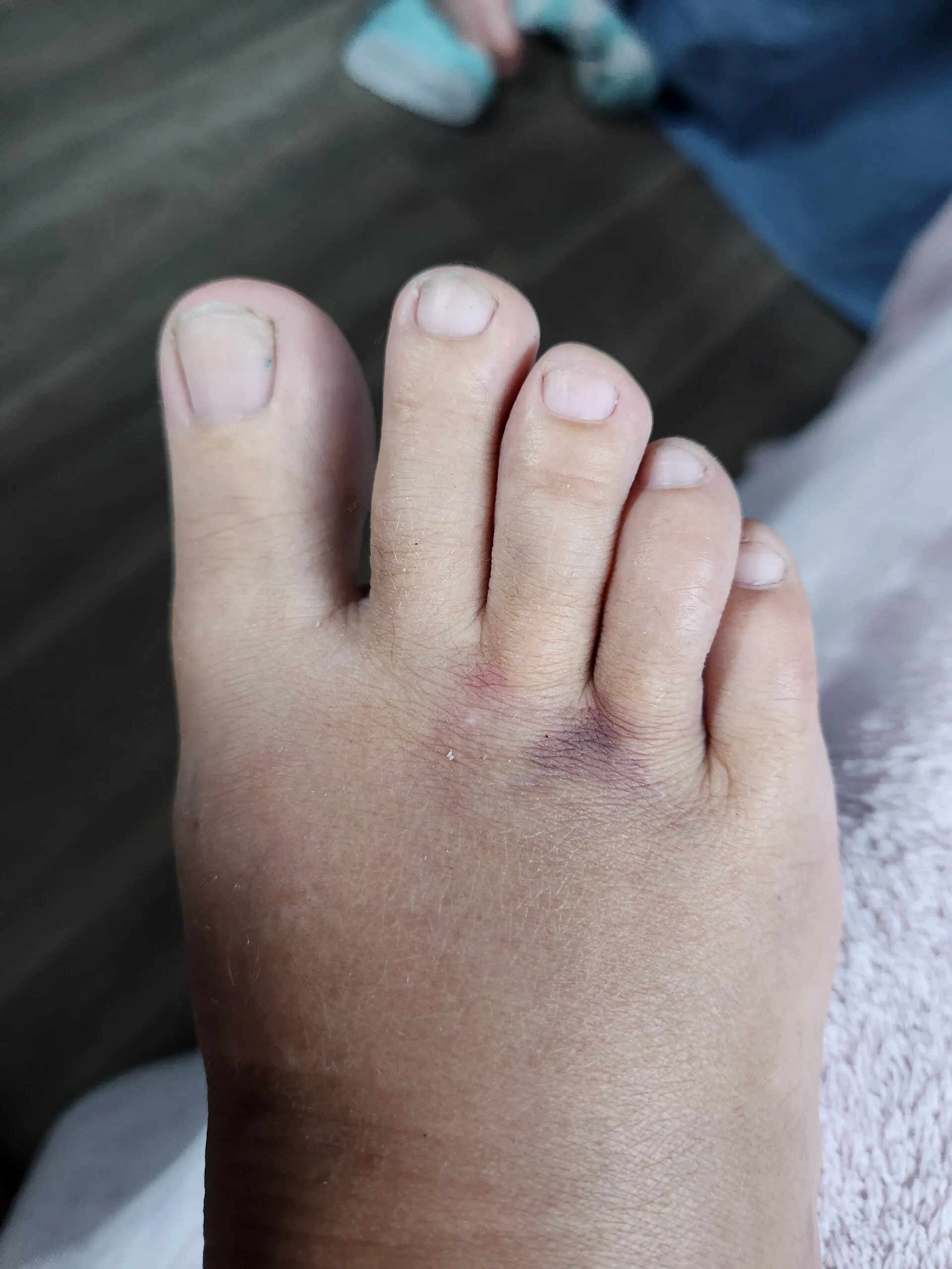 Image of bruised foot after wombat attack