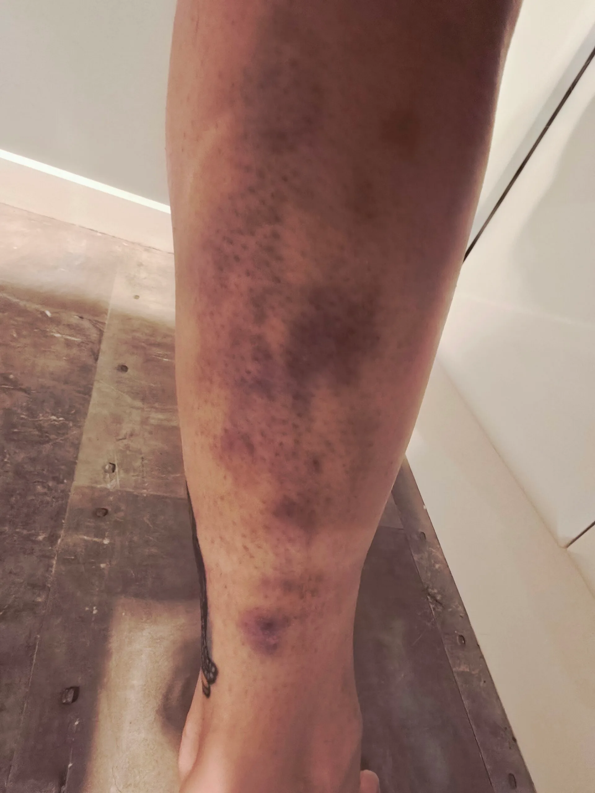Image of womans bruised calf after wombat attack
