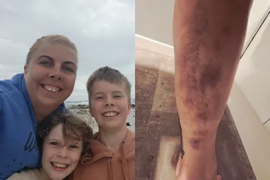 Left image - Mum and children on camping trip Right image - bruised leg after wombat attack