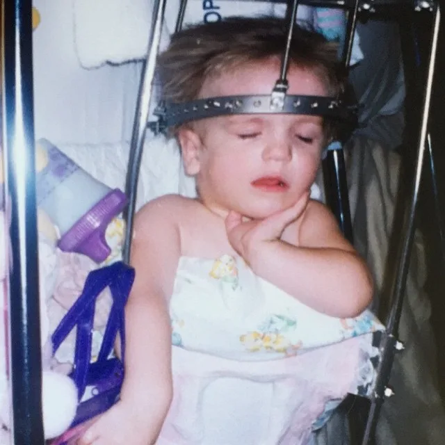 Photo of baby with a medical head stabiliser.