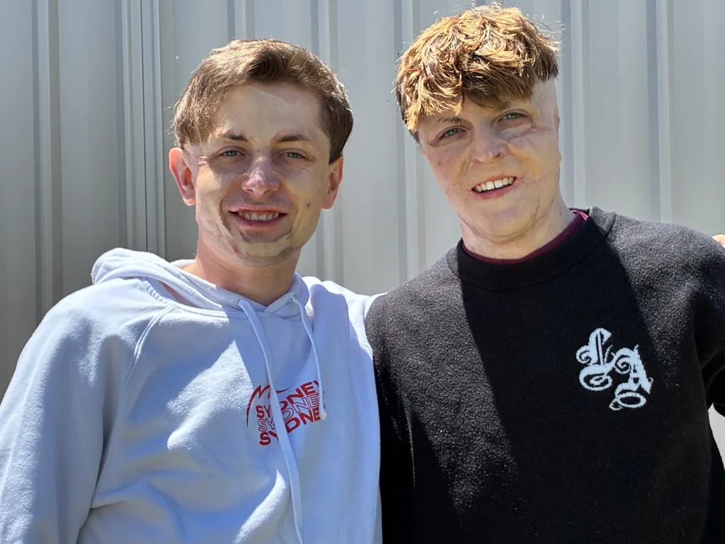 Image of brothers with facial burns