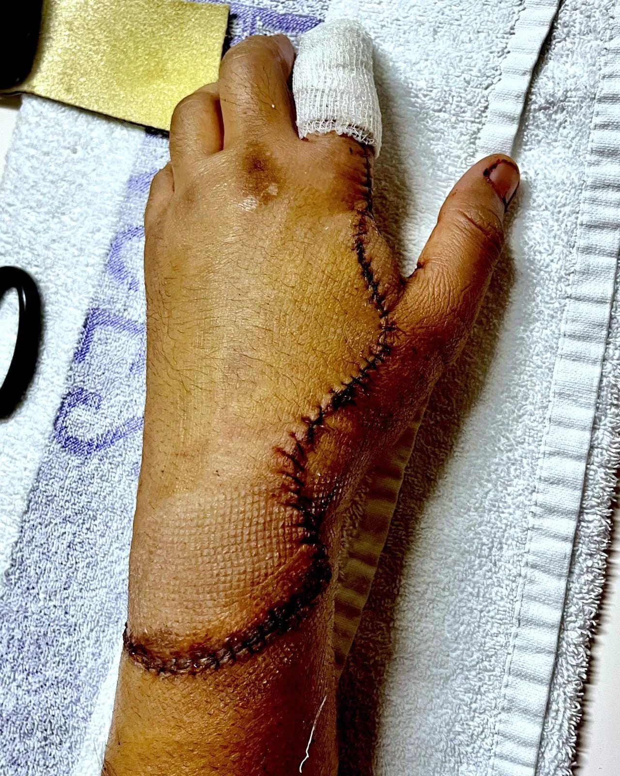 Picture of arm with large stitch upto index finger.