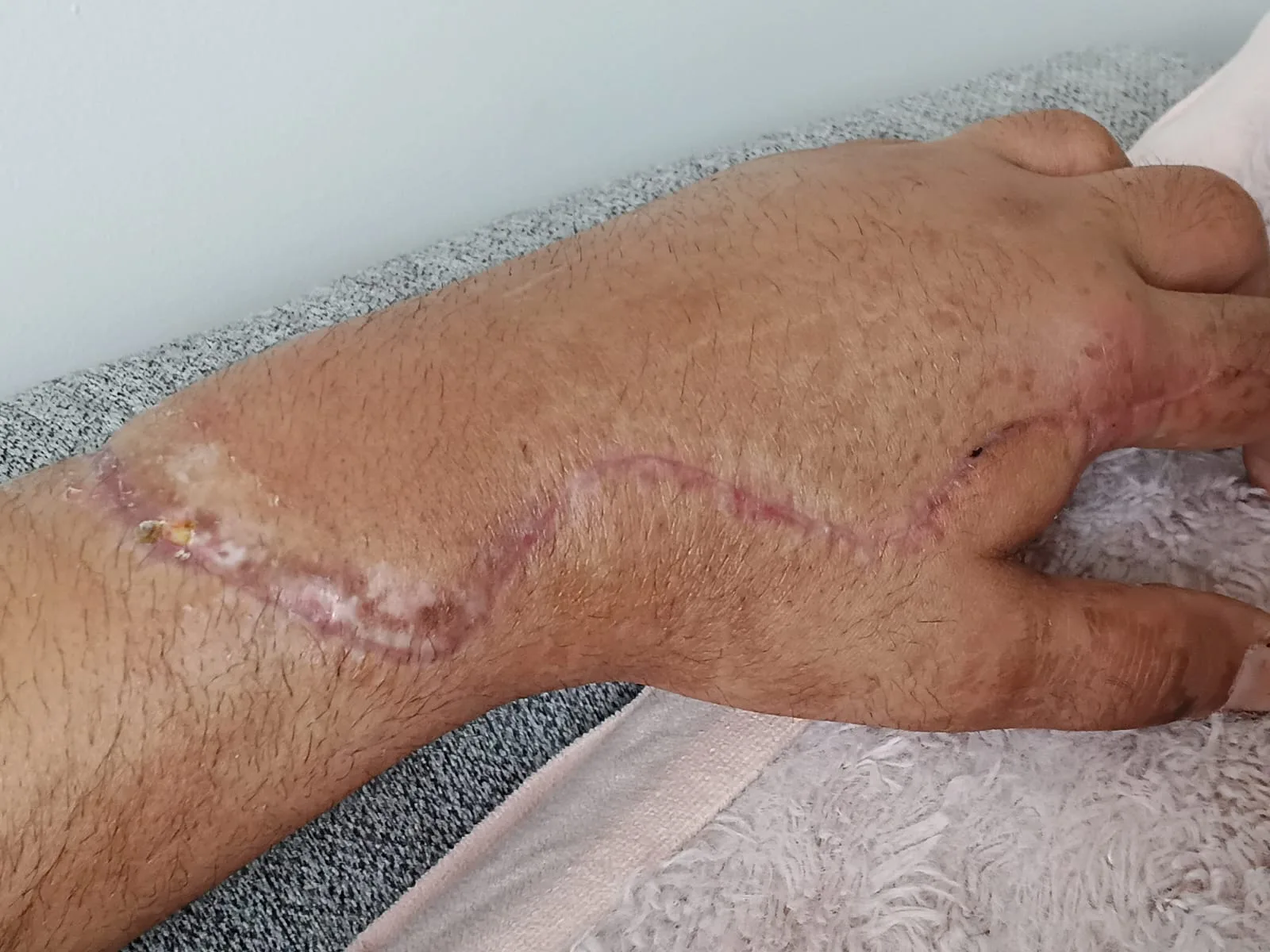 Photo of arm with extensive healed wound.