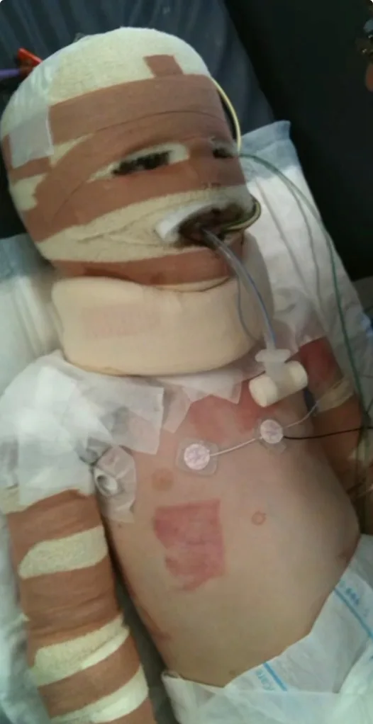 Image of boy recovering from burns in hospital