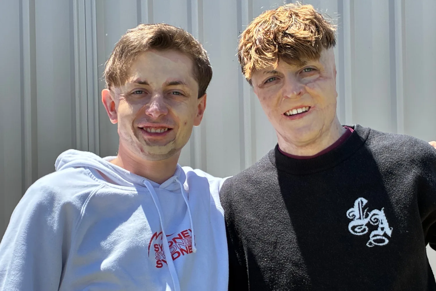 Image of two brothers with burns