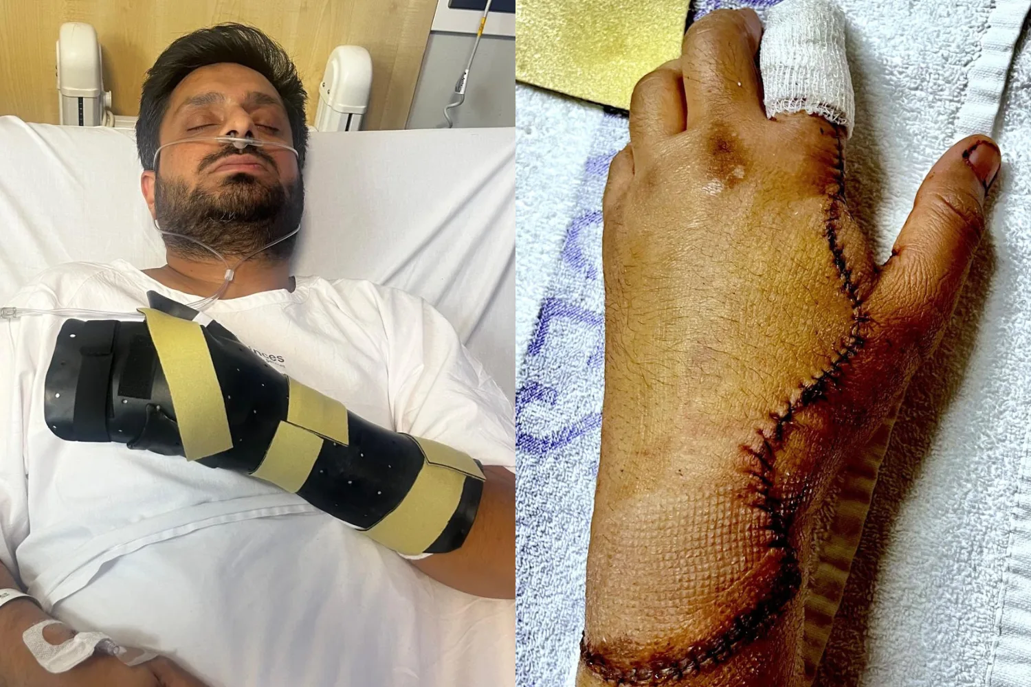 Right: Picture of arm with large stitch upto index finger.