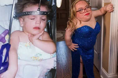Left: Photo of baby with a medical head stabiliser. Right: Girl with blonde hair wearing glasses and blue sparkly dress, posing next to door.