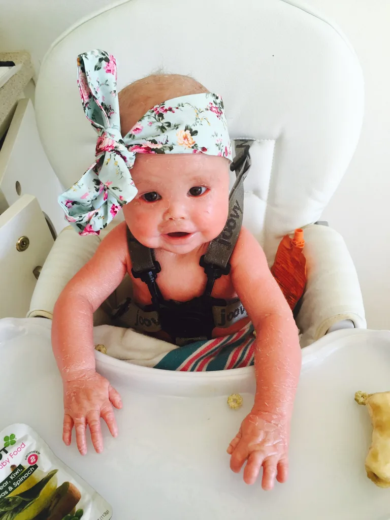 Image of newborn with skin condition