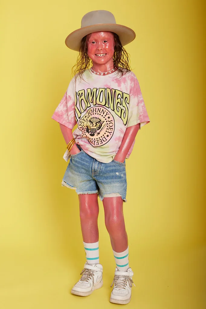 Image of girl living with skin condition