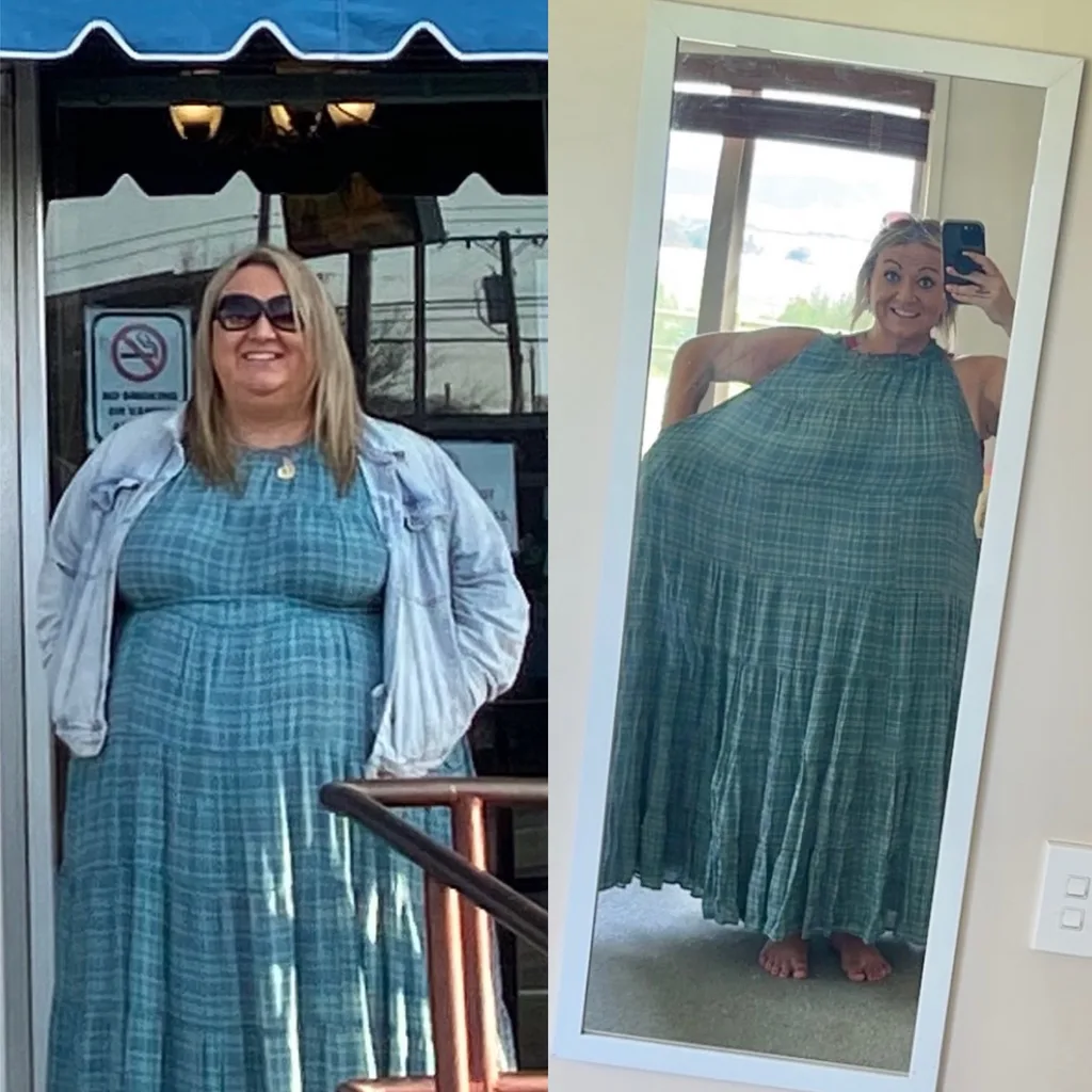 image of before and after weight loss surgery