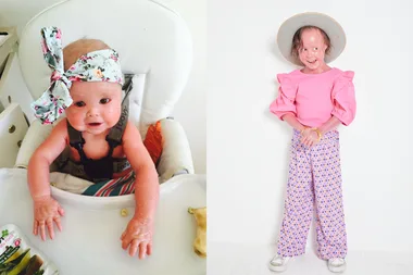 Left image - baby born with harlequin ichthyosis Right image - girl living with rare skin condition