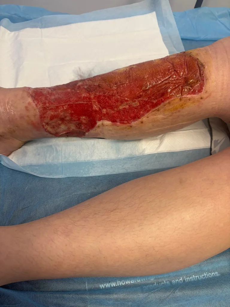 Amanda's leg with the BTM dressing