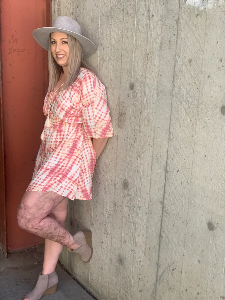 Image of woman wearing pink dress and hat showing leg burns