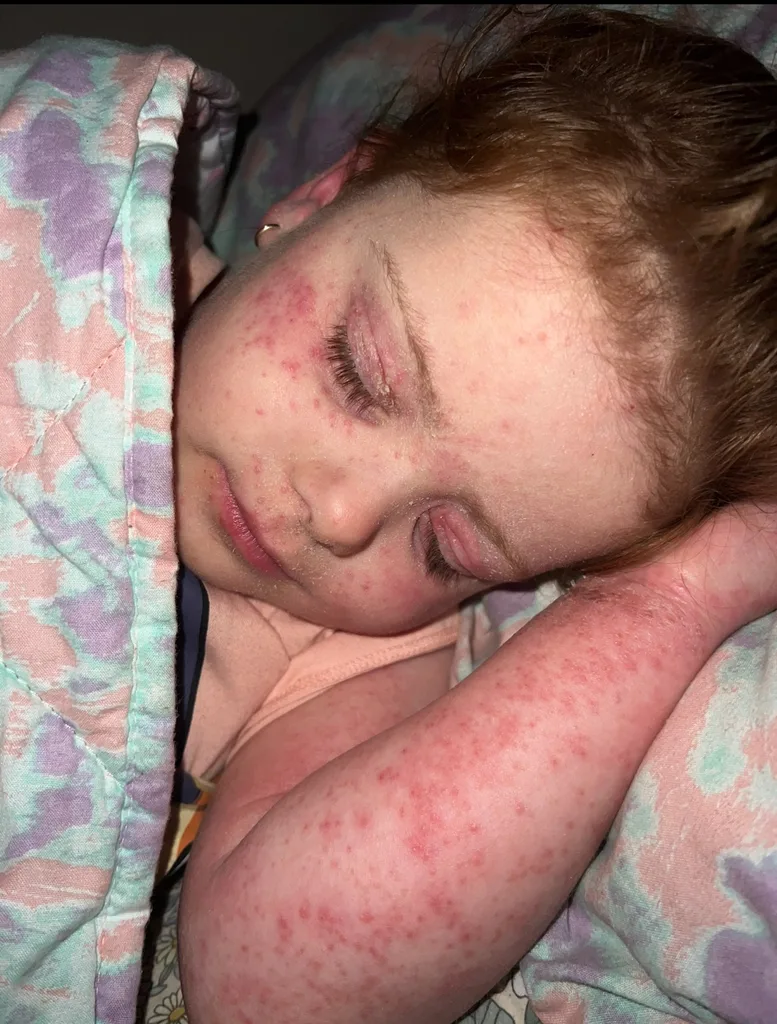 Image of young girl battling eczema