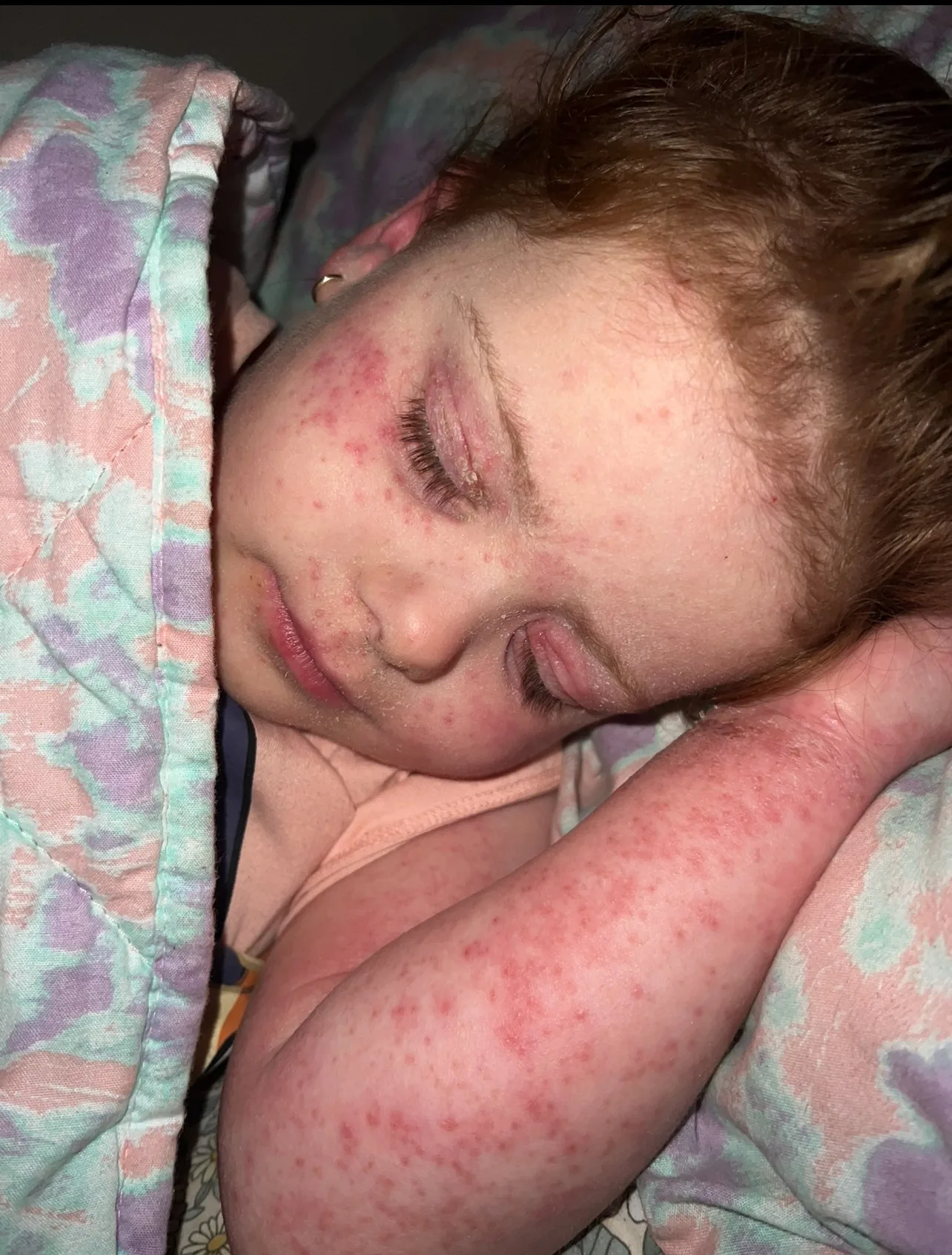 Image of young girl battling eczema