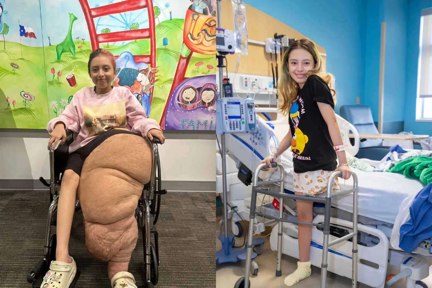 Left image - girl with big leg Right image - girl with amputated leg