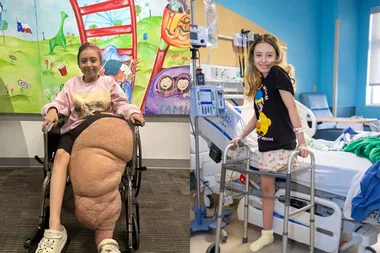 Left image - girl with big leg Right image - girl with amputated leg