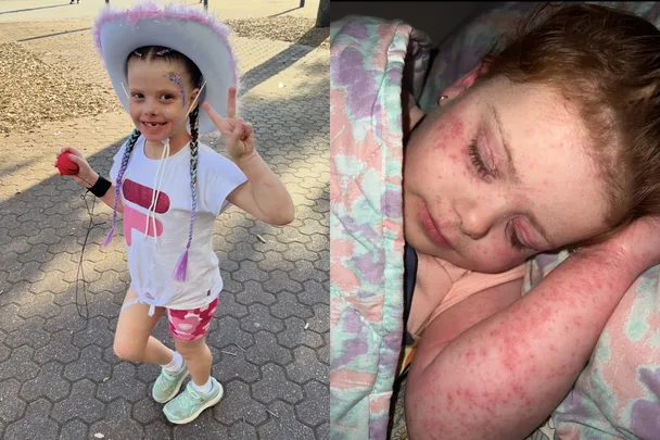 Doctors thought my baby had acne…the truth nearly killed her