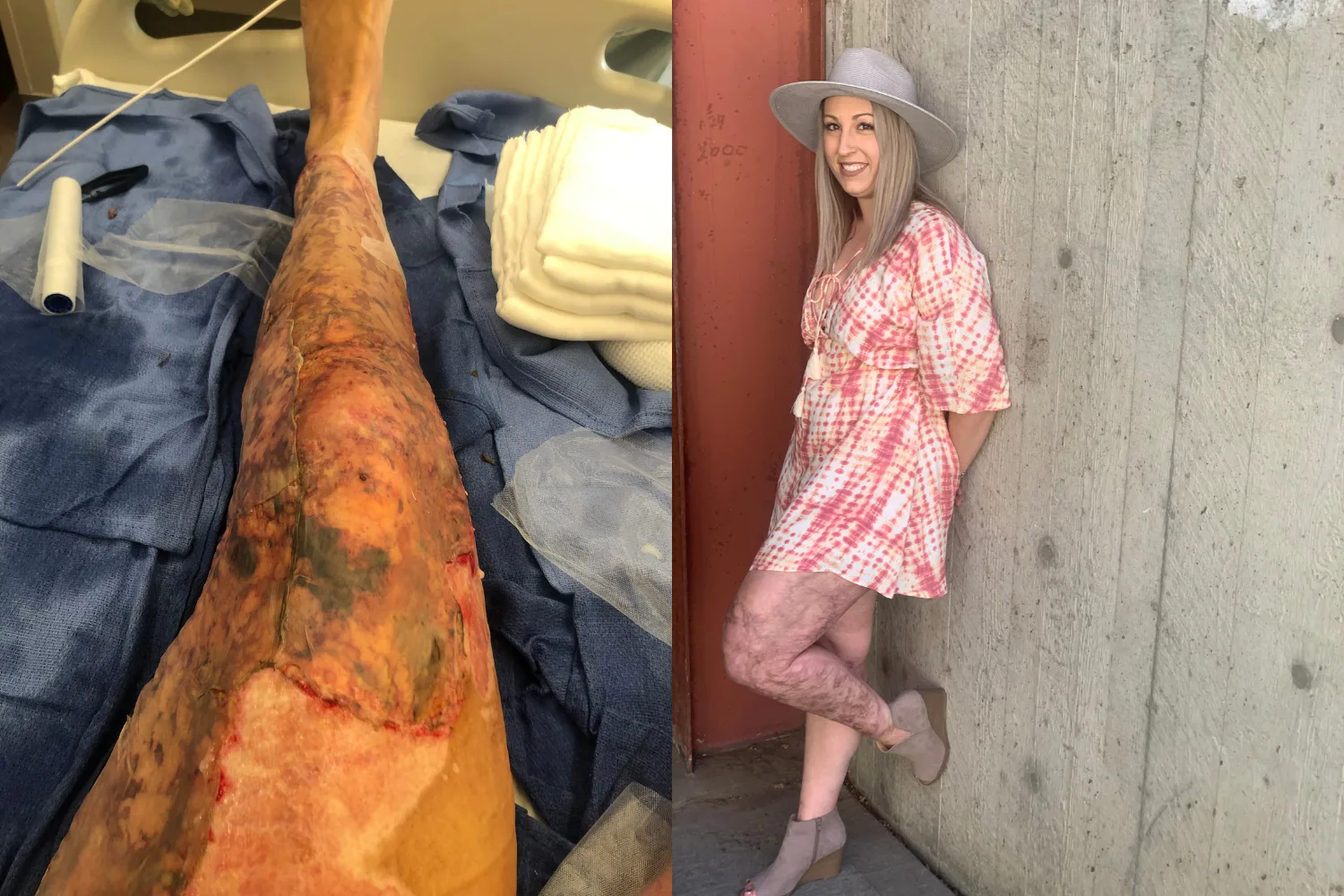 Left image - Womans burns after falling into campfire RIght image - Woman wearing pink dress and hat with leg burns
