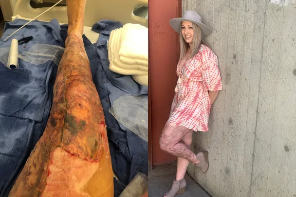 I was barbecued alive on my birthday camping trip