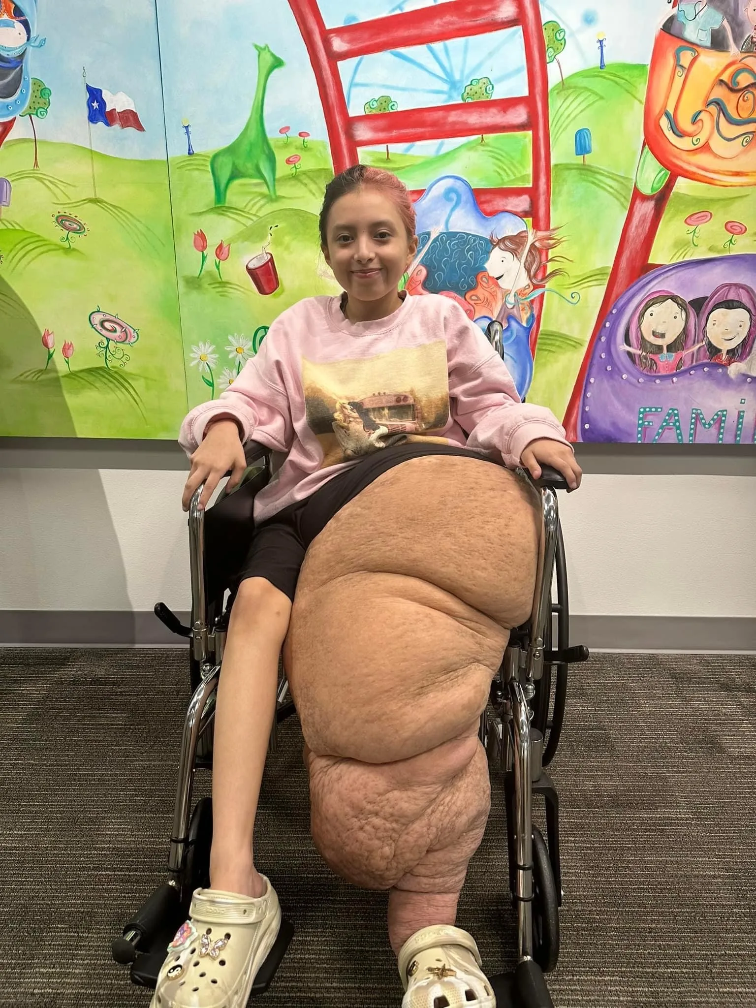 Image of girl with enlarged leg