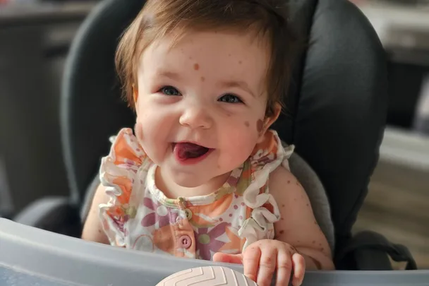 ‘It’s just a birthmark’: The rare disease hidden inside my baby’s brain