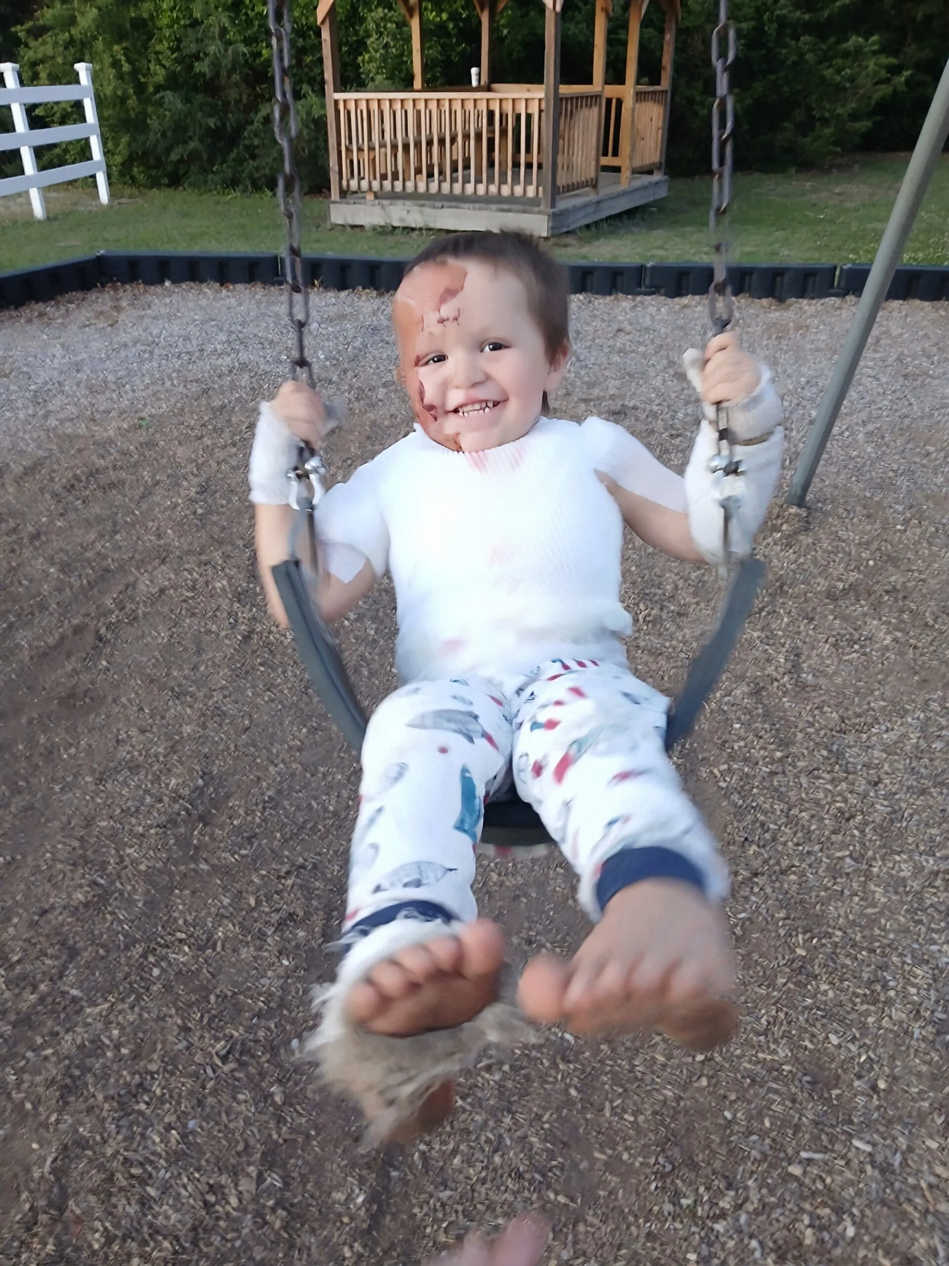 Little boy with skin graft sitting on a swing and smilling at camera.