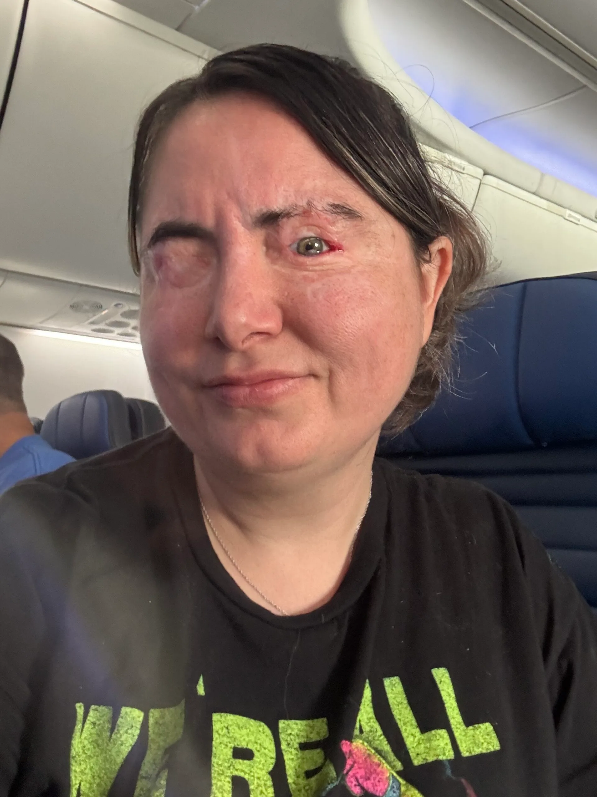 Image of woman recovered from acid burns