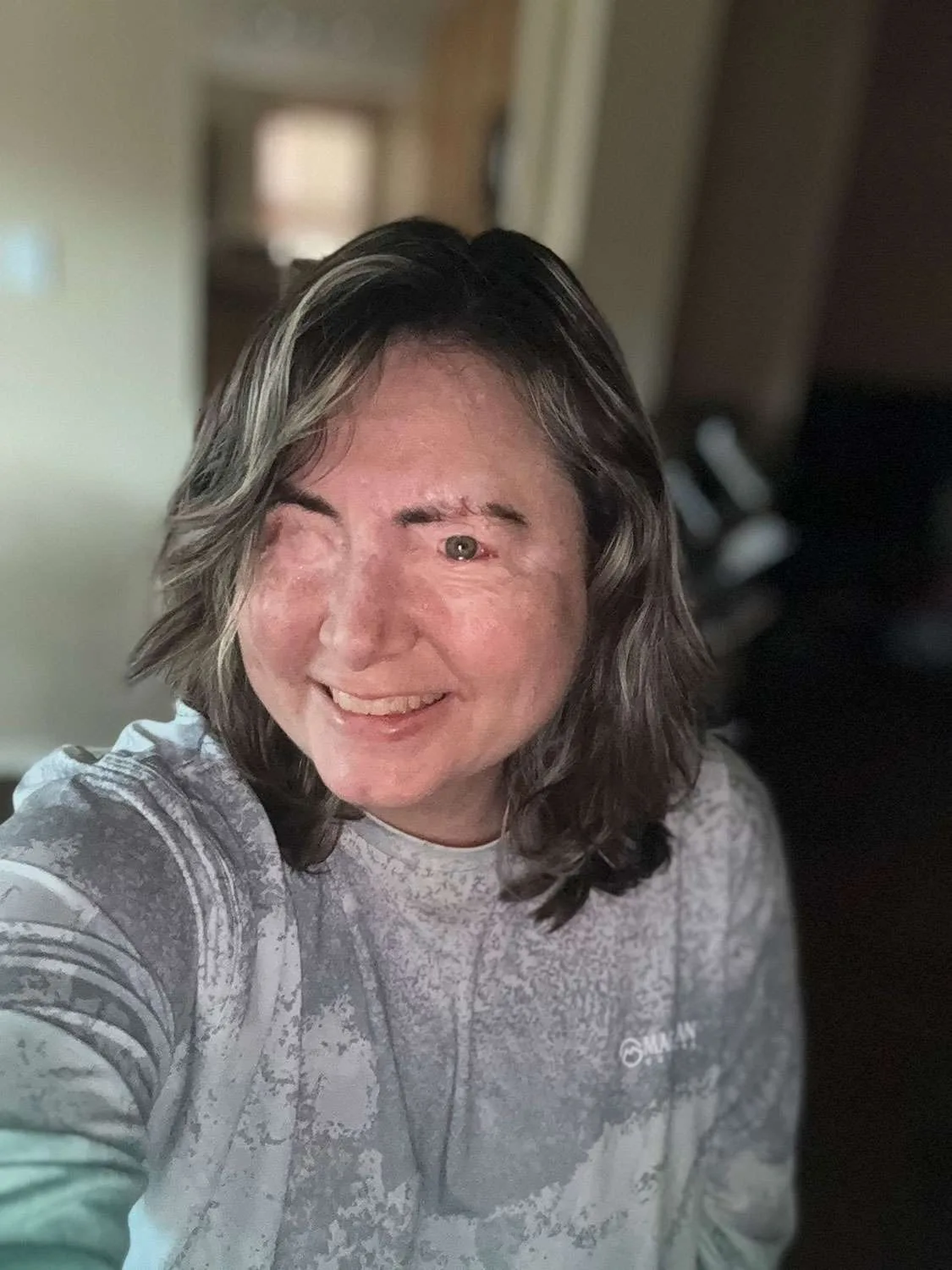 Image of woman after acid attack