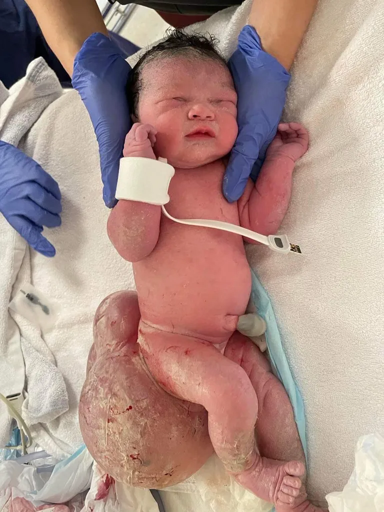 Image of newborn with teratoma