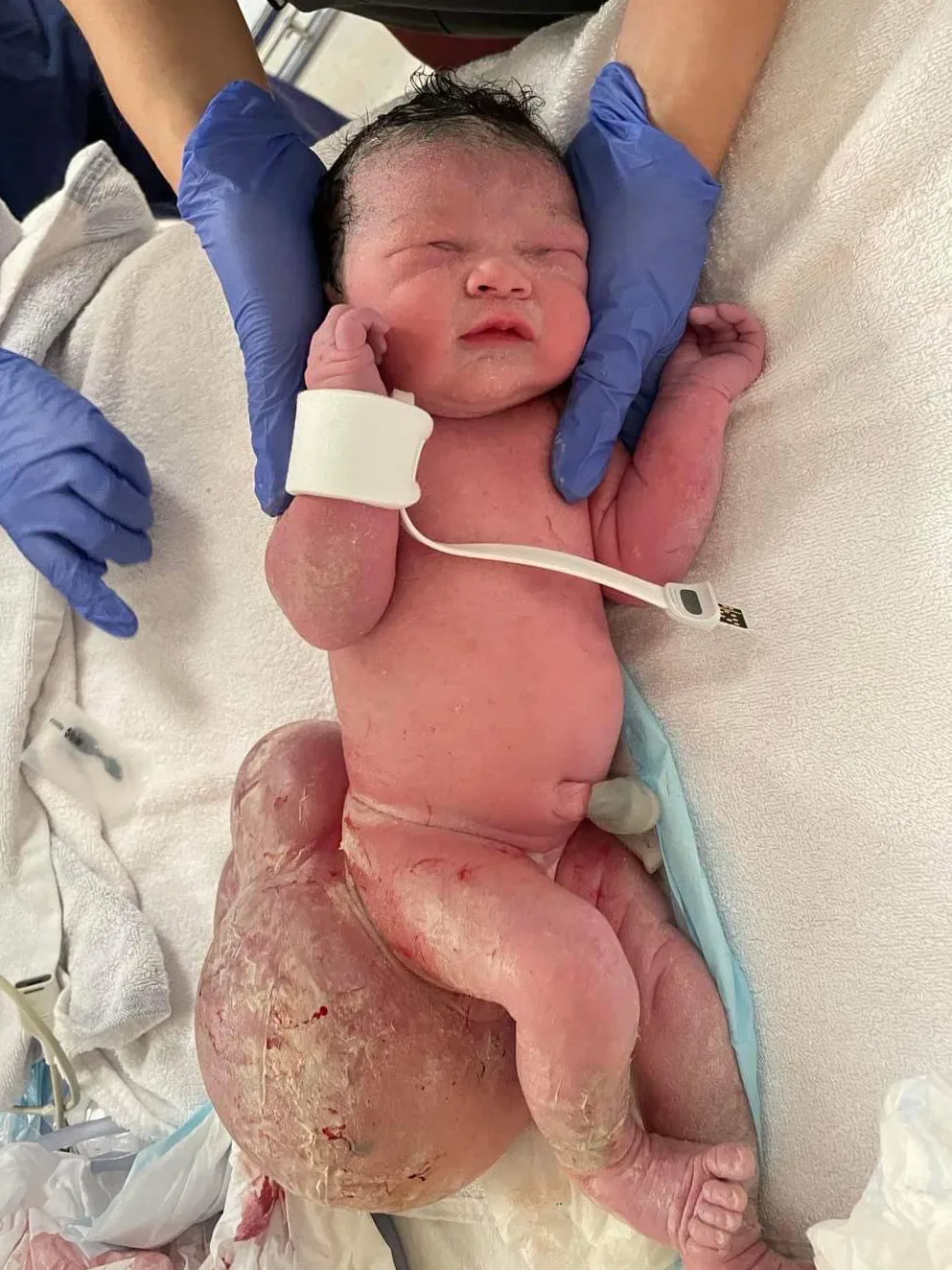 Image of newborn with teratoma