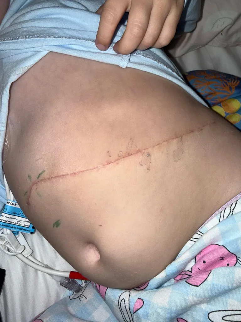 Olivia's surgery scar