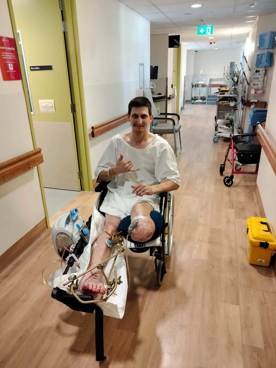 Man in hospital gown, sitting on wheelchair and right leg amputated.