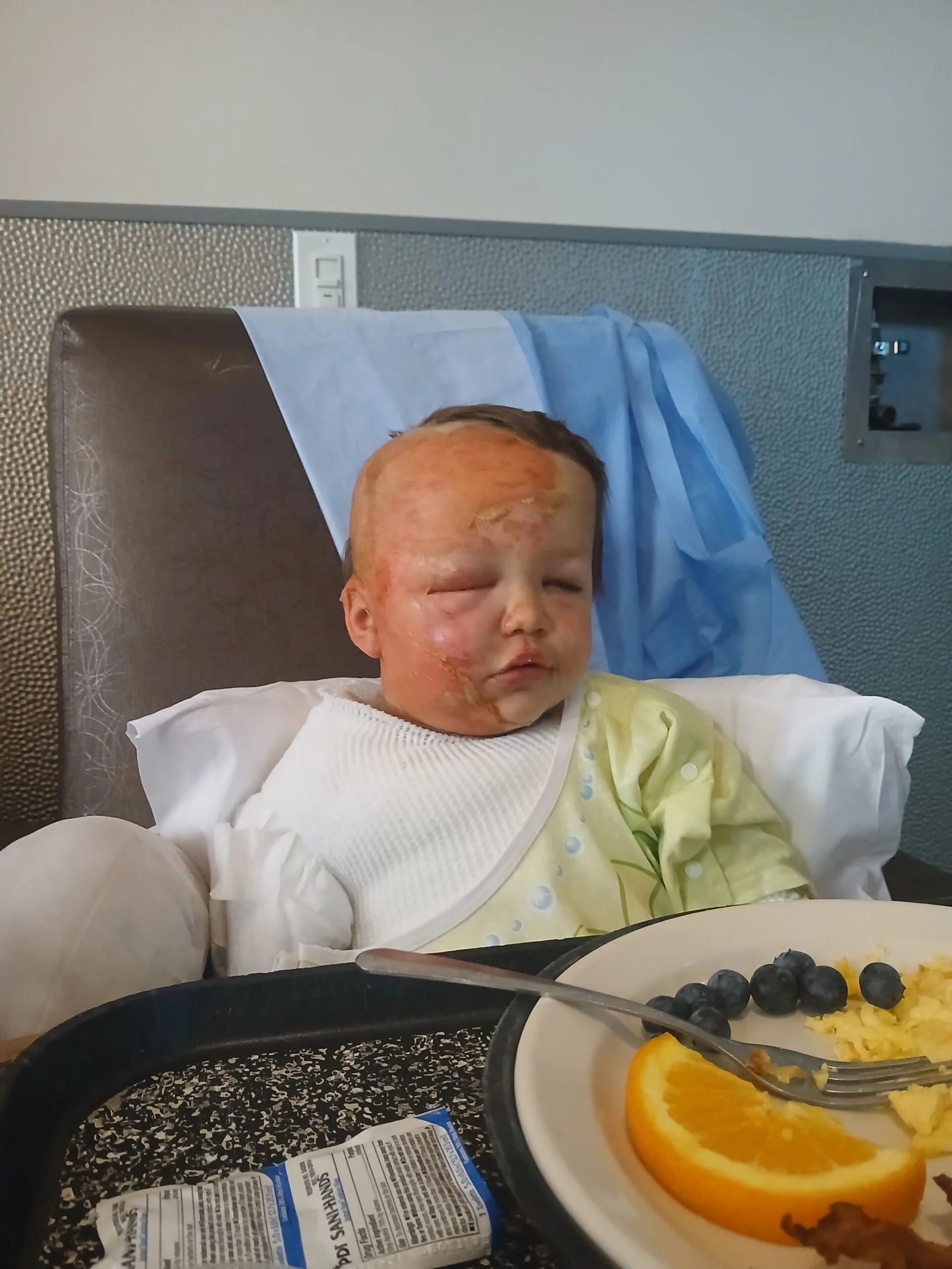 Little boy with skin graft, covered in bandages and sitting on hospital chair,.