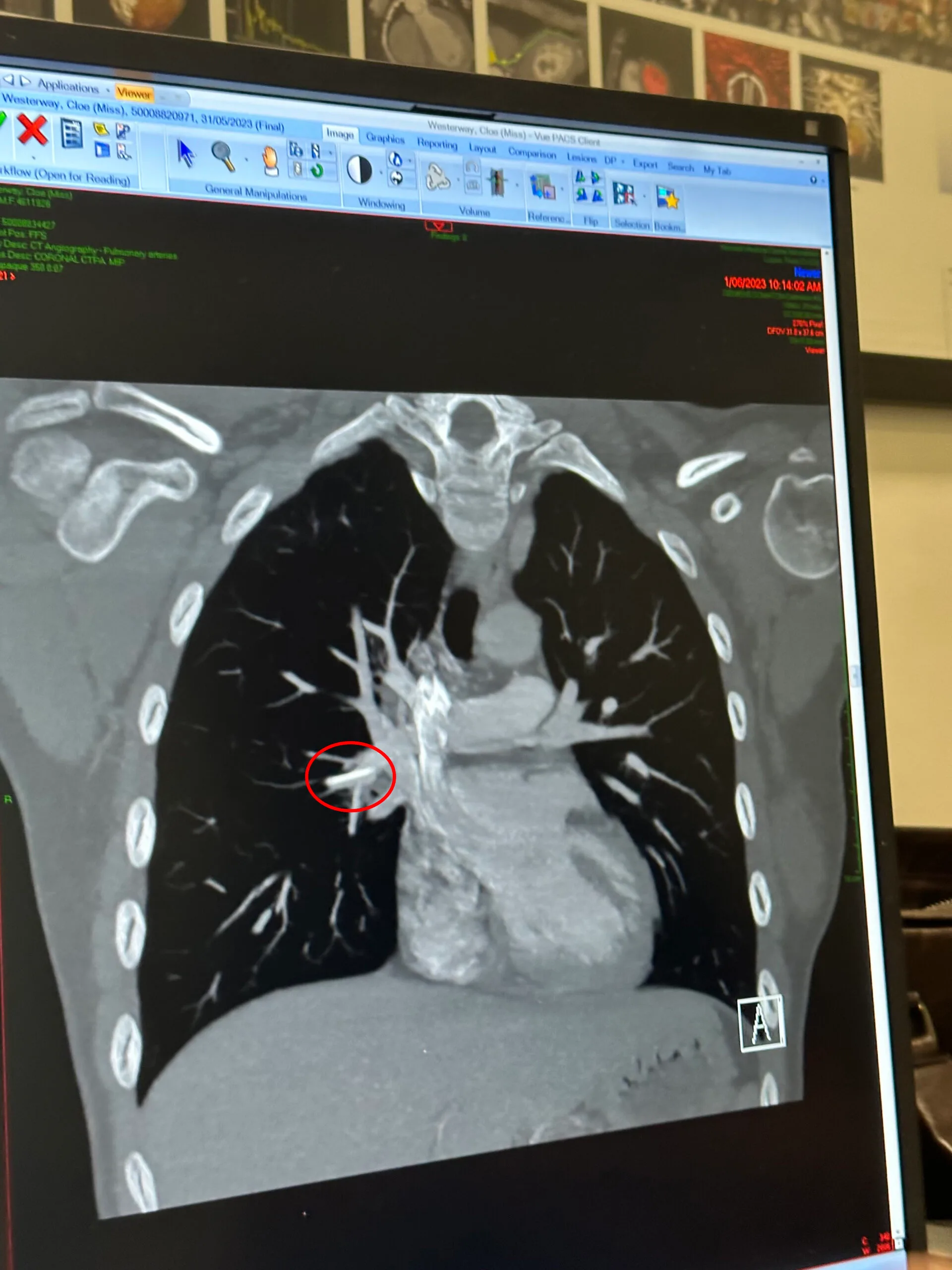 Image of heart x-ray